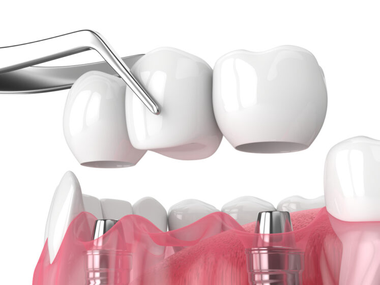 dental implants technology